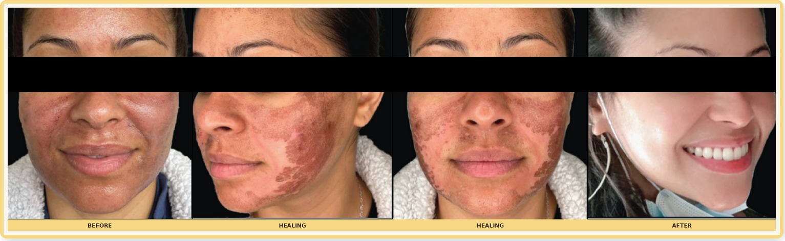 Before, healing, and after photos of a NOUVADerm facial laser treatment showing improved skin tone; eyes covered for privacy