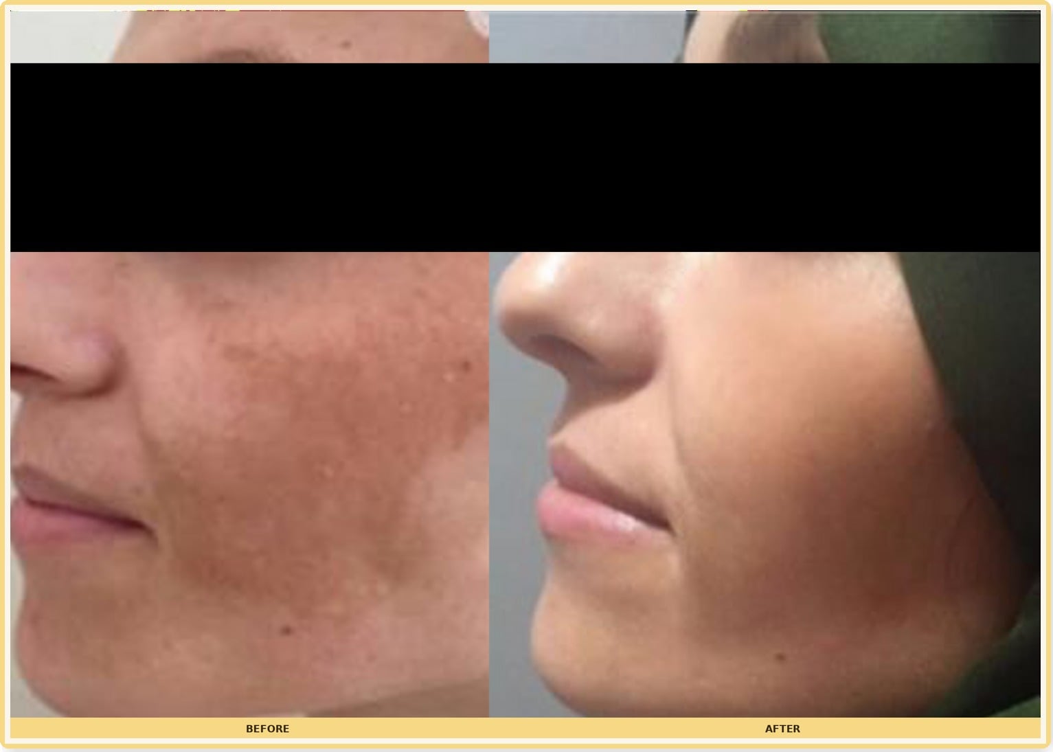 Before and after cheek pigmentation improvement after NOUVADerm; eyes covered for privacy