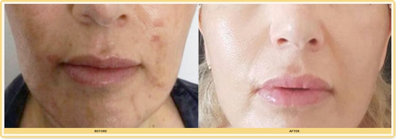 Before and after close-up of lower face showing clearer skin after NOUVADerm treatment