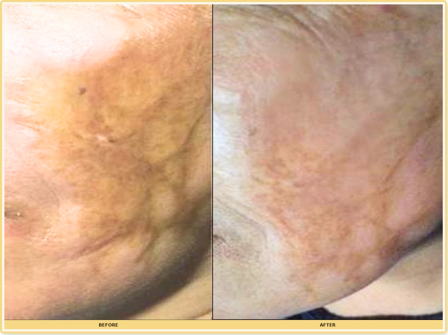 Before and after close-up of facial skin texture and pigmentation after NOUVADerm treatment